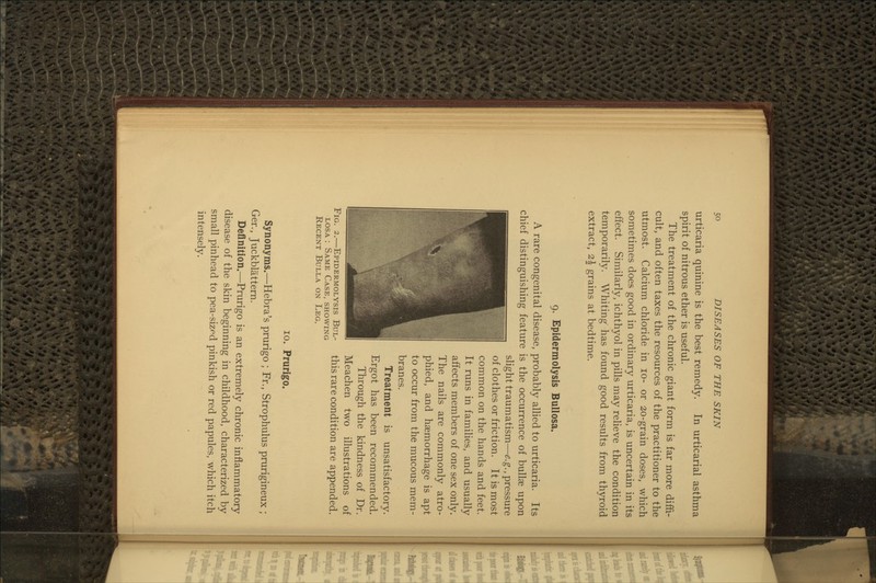 urticaria quinine is the best remedy. In urticarial asthma spirit of nitrous ether is useful. The treatment of the chronic giant form is far more diffi- cult, and often taxes the resources of the practitioner to the utmost. Calcium chloride in lo- or 20-grain doses, which sometimes does good in ordinary urticaria, is uncertain in its effect. Similarly, ichthyol in pills may relieve the condition temporarily. Whiting has found good results from thyroid extract, 2| grains at bedtime. 9. Epidermolysis Bullosa. A rare congenital disease, probably allied to urticaria. Its chief distinguishing feature is the occurrence of bullae upon slight traumatism—^.g., pressure of clothes or friction. It is most common on the hands and feet. It runs in families, and usually affects members of one sex only. The nails are commonly atro- phied, and haemorrhage is apt to occur from the mucous mem- branes. Treatment is unsatisfactory. Ergot has been recommended. Through the kindness of Dr. Meachen two illustrations of Fig. 2.—Epidermolysis Bul- this rare condition are appended. LOSA : Same Case, showing Recent Bulla on Leg. 10. Prurigo. Synonyms.—Hebra's prurigo ; Fr., Strophulus prurigineux ; Ger., Juckblattern. Definition.—Prurigo is an extremely chronic inflammatory disease of the skin beginning in childhood, characterized by small pinhead to pea-sized pinkish or red papules, which itch intensely.