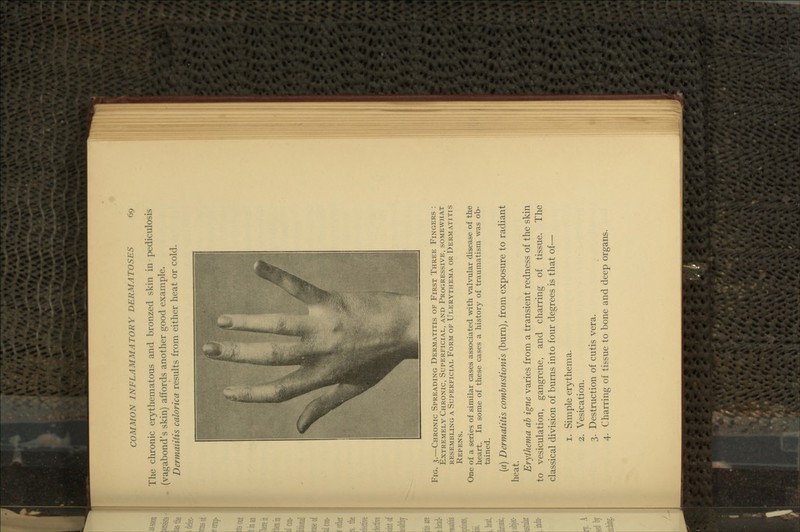 The chronic erythematous and bronzed skin in pediculosis (vagabond's skin) affords another good example. Dermaiiiis calorica results from either heat or cold. Fig. 3.—Chronic Spreading Dermatitis of First Three Fingers : Extremely Chronic, Superficial, and Progressive, somewhat resembling a Superficial Form of Ulerythema or Dermatitis Repens. One of a series of similar cases associated with valvular disease of the heart. In some of these cases a history of traumatism was ob- tained. (a) Dermatitis comhustionis (burn), from exposure to radiant heat. Erythema ah igne varies from a transient redness of the skin to vesiculation, gangrene, and charring of tissue. The classical division of burns into four degrees is that of— 1. Simple erythema. 2. Vesication. 3. Destruction of cutis vera. 4. Charring of tissue to bone and deep organs.