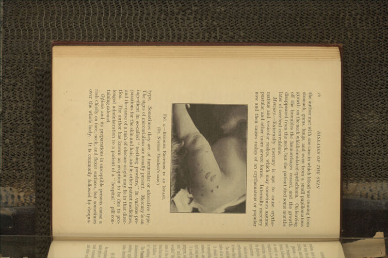 the author met with one case in which blood was coming from stomach, gums, lungs, and even from a small papillomatous growth on the neck which simulated epithelioma. On leaving off the bromides the haemorrhages ceased, and the growth disappeared from the neck, but the patient died some months later of cerebral convulsions. Mercury.—Externally mercury is apt to cause erythe- matous and vesicular rashes, which may sometimes assume pustular and other more severe forms. Internally mercury now and then causes rashes of an erythematous or papular Fig. 4.—Bromide Eruption in an Infant. (Dr. Norman Meachen's case.) type. Sometimes they are of furuncular or ulcerative type. The signs of mercurialism are usually present. Mercury is an ingredient in so-called  teething powders, in various pre- parations for the skin and hair, and in other patent medicines, and the cause of a rash of obscure origin may lie in that direc- tion. The author has known an eruption to be due to pro- longed administration to a patient of a  hospital  pill con- taining calomel. Opium and its preparations in susceptible persons cause a rash chiefly on face, neck, and flexor surfaces, but sometimes over the whole body. It is commonly followed by desqua-