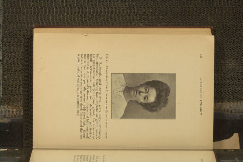 Fig. 25.—Congenital High Forehead and Exophthalmic Goitre, E. G., female, aged thirty-three years, single, swimming- bath attendant. Suffering from exophthalmic goitre; moder- ate exophthalmos; enlarged thyroid gland; fine tremors in hands; nervousness; pulse 100; depression; palpitation ; tinnitus; mild Raynaud's disease. Congenital high forehead, frontal band area partially covered with short hair. Symp- toms came on some years ago after shock (discovered that her reputed husband was already a married man).