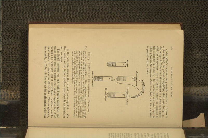 If the rabbit's corpuscles in 4 remain intact {i.e., if there is no haemolysis), the patient is syphilitic, the reason being that the antigen in Tube 1 and the sensitizer in Tube 2 have united with the complement (also in Tube 2) before the addition of the sensitizer in Tube 3. No haemolysis can take place in Tube 4 because the complement has been fixed, and the sensitizer is powerless to act alone. ^C^oUonor^^ Sensitiser alone Antigen Comptem ent a/ong Fig. Patient's blood. Rabbit's corpuscles. -Deviation of the Complement : Hemolysis. The patient is non-syphilitic. The complement which is naturally present in his blood (Tube 2) is left free, and is deviated to the sensitizer in Tube 3, so that complement in Tube 2 +sensitizer in Tube 3 = complete antibody. The complete antibody now attacks the rabbit's corpuscles in Tube 4, causing haemolysis, hence tur- bidity of fluid (the rabbit's corpuscles have lines drawn through them to indicate the haemolysis). In the next case, assume the patient is non-syphilitic. Mix the contents of the tubes as before, and place in an incubator for two hours. The liquid becomes red and turbid from haemolysis, the reason being that, the patient not having syphiHs, his blood contains no sensitizer, but it nevertheless contains comple- ment (which is common to all bloods). The complement, accordingly, in Tube 2 is free to act in conjunction with the