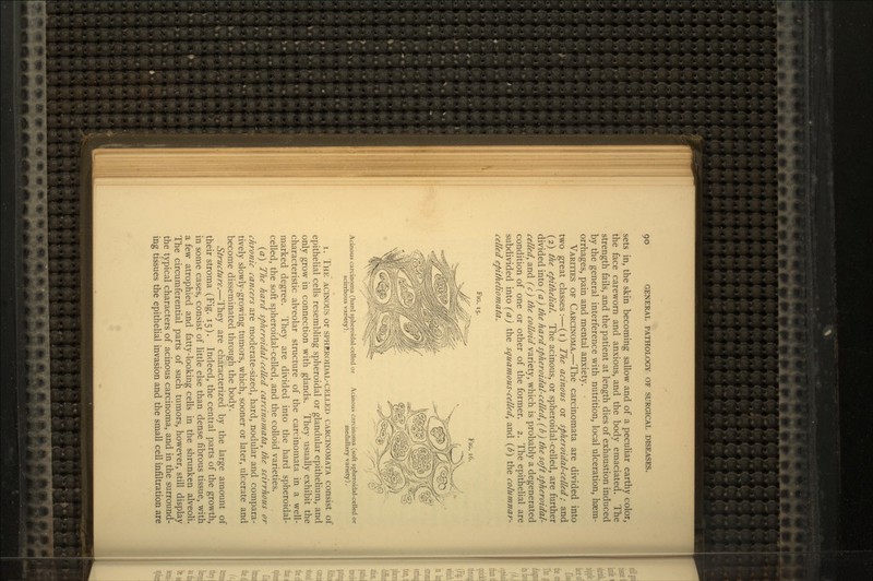 sets in, the skin becoming sallow and of a peculiar earthy color, the face careworn and anxious, and the body emaciated. The strength fails, and the patient at length dies of exhaustion induced by the general interference with nutrition, local ulceration, haem- orrhages, pain and mental anxiety. VARITIES OF CARCINOMA.—The carcinomata are divided into two great classes:—(i) The acinous or spheroidal-celled; and (2) the epithelial. The acinous, or spheroidal-celled, are further divided into (a) the hard spheroidal-celled, (b) the soft spheroidal- celled, and (c) the colloid variety, which is probably a degenerated condition of one or other of the former. 2. The epithelial are subdivided into (a) the squamous-celled, and (£) the columnar- celled epitheliomata. FIG. 15. FIG. 16. Acinous carcinoma (hard spheroidal-celled or scirrhous variety). Acinous carcinoma (soft spheroidal-celled or medullary variety). i. THE ACINOUS or SPHEROIDAL-CELLED CARCINOMATA consist of epithelial cells resembling spheroidal or glandular epithelium, and only grow in connection with glands. They usually exhibit the characteristic alveolar structure of the carcinomata in a well- marked degree. They are divided into the hard spheroidal- celled, the soft spheroidal-celled, and the colloid varieties. (a) The hard spheroidal-celled carcinomata, the scirrhous or chronic cancers are moderate-sized, hard, nodular and compara- tively slowly-growing tumors, which, sooner or later, ulcerate and become disseminated through the body. Structure.—They are characterized by the large amount of their stroma (Fig. 15). Indeed, the central parts of the growth, in some cases, consist of little else than dense fibrous tissue, with a few atrophied and fatty-looking cells in the shrunken alveoli. The circumferential parts of such tumors, however, still display the typical characters of acinous carcinoma, and in the surround- ing tissues the epithelial invasion and the small cell infiltration are