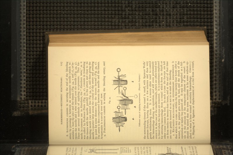 8. ACUPRESSURE consists in securing the end of the bleeding artery by pressing it between an acupressure needle (which re- sembles a hare-lip pin) and the tissues (Fig. 34, i and 2), or be- tween the needle and a wire twisted over the needle (Fig. 34, 3). There are several methods of applying acupressure. That for- merly.in common use in Aberdeen, the  Aberdeen twist, as it was called by Professor Pirrie (Fig. 34, 2), consists in transfixing the tissues with the needle parallel to the artery and close to its bleeding mouth (see dotted line Fig. 34, 2), and then giving the needle a quarter twist across the course of the artery and pressing its point for some distance into the tissues beyond (Fig. 34, 2). The artery is thus compressed between the needle and the tissues. Acupressure is scarcely ever used now. 9. FORCIPRESSURE consists in seizing the bleeding artery, and Fig. 34- Different ways of applying acupressure. (Bryant's Surgery.) the surrounding tissues if the vessel is small, with Spencer Wells' pressure forceps, leaving them on a few minutes and then very gently withdrawing them. It is a means often used to control the haemorrhage during an operation, and will even permanently arrest it in the case of the smaller vessels, which are often found not to bleed when the forceps are removed. It is sometimes employed for arresting haemorrhage from a vessel which from its depth or other cause cannot be tied. In such a case the forceps are left on from twelve to twenty-four hours, and at the end of that time are very gently removed so as not to re-start the bleeding. 2. RECURRENT REACTIONARY, OR INTERMEDIARY HEMORRHAGE is that which may come on within the first twenty-four hours after a wound, as the patient gets warm in bed, and the shock of the operation or injury has passed off. It may be regarded as a fail- ure in the process of the temporary closure of the vessel. It should be noted that the term recurrent is by some authors ap- plied to what is here termed secondary haemorrhage. Causes.— i. Slipping of a ligature or displacement of a clot from a vessel,