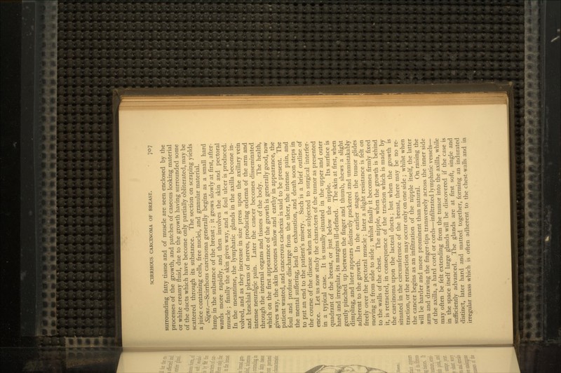 surrounding fatty tissue and of muscle are seen enclosed by the processes of the growth, and patches of caseous looking material or white creamy fluid, due to the growth having surrounded some of the ducts which have become only partially obliterated, may be scattered through its substance. The section on scraping yields a juice containing cells, free nuclei, and granular material. Signs.—Scirrhous carcinoma generally begins as a small hard lump in the substance of the breast; it grows slowly at first, after- wards more rapidly, and then involves the skin and pectoral muscle ; finally the skin gives way, and a foul ulcer is produced. In the meantime, the lymphatic glands in the axilla become in- volved, and as they increase in size press upon the axillary vein and brachial plexus of nerves, producing oedema of the arm and intense neuralgic pain. Later the cancer becomes disseminated through the internal organs and tissues of the body. The health, which on the first appearance of the growth is generally good, now gives way, the skin becomes sallow and earthy in appearance, the patient wasted, and cancerous cachexia is said to be present. The foul and profuse discharge from the ulcer, the intense pain, and the mental suffering, lead to exhaustion, and death soon steps in to put an end to the patient's misery. Such is a brief outline of the course of the disease when not subjected to surgical interfer- ence. Let us now study the characters of the tumor as presented in a typical case. It is usually situated in the upper and outer quadrant of the breast, or just below the nipple. Its surface is hard and irregular, its margins ill-defined. The skin at first, when gently pinched up between the finger and thumb, shews a slight dimpling, and later appears distinctly puckered and unmistakably adherent to the growth. In the earlier stages the tumor glides freely over the pectoral muscle; later a slight resistance is felt on moving it from side to side; whilst finally it becomes firmly fixed to the walls of the chest. The nipple, when the growth is behind it, is retracted, in consequence of the traction which is made by the carcinoma upon the lacteal ducts; but when the growth is situated in the circumference of the breast, there may be no re- traction, or the retraction may occur only on one side ; whilst when the cancer begins as an infiltration of the nipple itself, the latter will be harder and more prominent than natural. On raising the arm and drawing the finger-tips transversely across the inner side of the axilla, a hard cord or cords—infiltrated lymphatic vessels— may often be felt extending from the tumor into the axilla, while in the space itself large glands will be discovered if the case is sufficiently advanced. The glands are at first soft, single and distinct, later hard and matted together, forming an indurated irregular mass which is often adherent to the chest-walls and in