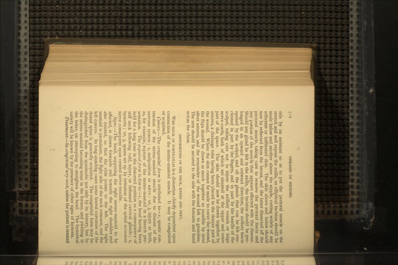 side by an assistant so as to put the pectoral muscle on the stretch and well expose the axilla, an elliptical incision should be made below and another above the nipple, cutting widely of any adherent or infiltrated skin. The skin above and below should now be reflected from the breast, and the latter dissected off the pectoral muscle, taking care to remove the pectoral fascia and any portion of the muscle that appears affected with the disease. Should any gland be felt in the axilla, the incision should be pro- longed in an upward and outward direction, the axillary fascia opened by the scalpel, and all the glands that can be felt enu- cleated in part by the 'fingers, and in part by the handle of the scalpel, taking care not to injure the axillary vessels or large nerve-cords, both of which are situated at the upper and outer part of the space. The skin should now be drawn together by sutures, a drainage tube having been placed in the deeper part of the wound. Where the skin cannot be made to cover the wound, the flaps should be drawn as much together as possible by stout silver sutures, and the remainder of the wound left to granulate. The arm should be secured to the side with the forearm and hand across the chest. DEFORMITIES OF THE NECK, KNEES AND FEET. WRY-NECK or TORTICOLLIS is a distortion chiefly dependent upon contraction of the sterno-mastoid muscle. It may be congenital or acquired. Causes*—The congenital form is attributed to—i, spastic con- traction of the sterno-mastoid muscle due to disease of the nervous system ; 2, malposition in utero; or, 3, injury at birth, as, for example, rupture of the sterno-mastoid in a breech pre- sentation. The acquired form is due to—i, the head having been held for a long time in the distorted position as a consequence of stiff neck following cold, injury, or inflamed cervical glands; 2, hysteria; or, 3, spasm set up by irritation of the spinal accessory nerve consequent upon central nerve-trouble. Signs.—The head, supposing the right sterno-mastoid to be affected, is drawn forwards and towards the right shoulder and also rotated, so that the chin points to the left. The right mastoid is prominent, the right side of the neck concave, and the left convex. In long-standing cases some lateral curvature of the dorsal spine is generally acquired. The congenital form may be distinguished from the spasmodic not only by its history, but by the sterno-mastaid becoming tense in the former, and yielding in the latter, on attempting to straighten the head. The hysterical variety will be known by the presence of other signs of hysteria. Treatment.—In congenital wry-neck, unless the patient is treated