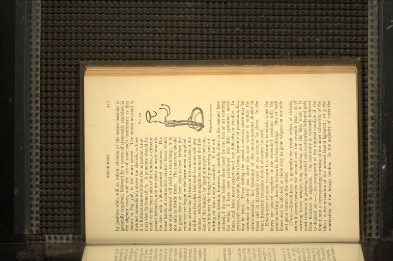KNOCK-KNEE. FIG. 308. Wry-neck apparatus. by position while still an infant, division of the sterno-mastoid is generally required, followed by a course of systematic exercises in the slighter cases, and the use of some such instrument as that shown in Fig. 308, in the more severe. The sterno-mastoid is divided immediately above the clavicle, as here it is furthest removed from the important struc- tures that lie beneath it. A puncture should be made at the inner side of the tendon, a director passed behind it, and the division made towards the skin with a blunt-pointed tenotome. The tense bands of contracted cervical fascia which now start forward will yield to stretching; it is not safe to divide them. The puncture should be given three or four days to heal before the exercises are begun or the instrument is applied. Some advise the division of the muscle about the middle, on the plea that such is a more safe pro- cedure ; whilst others again recommend the divi- sion of the tendon by open antiseptic incision, as in this way the danger of puncturing and ad- mitting air into a vein is avoided. If the sub- cutaneous division, however, is carefully done in the manner here advised, I do not believe there need be any fear of air entering the veins. I have now performed this little operation many times, and have never experienced any difficulty or trouble. In spasmodic cases, conium, Indian hemp, bromide of potassium, &c., may be'tried. These failing, the spinal accessory nerve may be stretched or divided just above the spot where it enters the sterno-mastoid; but tenotomy of the sterno-mastoid should in these and in hysterical cases on no account be done. In the latter, hysterical remedies should of course be used. KNOCK-KNEE or GENU VALGUM is a deformity in which, when the knees are placed together in the extended position with the patellae looking directly forwards, the legs diverge. One or both knees may be affected, or there may be genu valgum on one side and genu varum on the other. Cause.—Knock-knee is generally the result either of rickets, when it occurs between the second and the seventh year; or of carrying heavy weights, long standing and the like, when it is most common in growing, underfed and overworked lads and girls from fourteen to eighteen. The deformity is variously believed to depend on :—i, an overgrowth of the internal condyle of the femur, and a corresponding uprising of the inner tuberosity of the tibia; 2, the relaxation of the internal lateral ligament; or 3, the contraction of the biceps tendon. In the majority of cases the