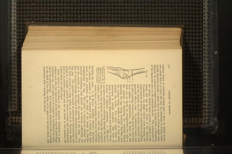F:G. 309. osseous lesion is certainly present, and I have no doubt in my own mind that it is upon this that the deformity in rickety cases usually depends, though I admit that in some of those rapid cases induced by excessive weight-bearing in weakly lads, a relaxation of the ligaments may be the principal factor. The contraction of the biceps tendon when present I regard as the result, and not as the cause, of the affection. Treatment.—In slight rickety cases keeping the child entirely off its legs, the application of splints, and the internal use of appropriate remedies, will generally effect a cure. In confirmed cases, and in older patients, however, little must be expected from splints or instruments. By their use the limb can no doubt be straightened, but only at the expense of stretching the external lateral ligament, the legs being rendered flail-like, and the patient being unable to walk or even stand without his irons. For such some form of osteotomy is usually required. The best of these is, perhaps, Macewen's and Reeves' Modi- fication of Ogston's operation, i. Maceiven's A, ime of section in operation consists in chiselling through the femur bgsttm's; Sa'nd c, in just above the epiphysis, but leaving the posterior o^uSf's™^edratioend sur^ace> which is in contact with the popliteal artery, intact, and snapping this across by forcibly bending the bone. 2. In Reeves'1 modified Ogston's operation the internal condyle is first loosened with a chisel, and then made to slide upwards on the shaft of the femur by forcibly straightening the leg. The chisel is introduced behind the synovial membrane, and should not be driven sufficiently far into the condyle as to endanger the opening of the joint. The line of incision through the femur in these operations is shown in Fig. 309. The operations should be performed antiseptically and the limb secured to a long splint, or placed in Bavarian plaster splints in a straight position for about a month, and subsequently kept in an ordinary plaster case for six weeks to two months, till sound union has taken place. GENU VARUM, or BOW-LEGS, is the opposite deformity to genu valgum, and what has been said of the latter as regards pathology, treatment, &c., will apply to it if external be substituted for inter- nal in the phraseology. It is frequently associated with a bowing of the shaft of the tibia, either at its upper or its lower third, and sometimes with a bowing of the femur.