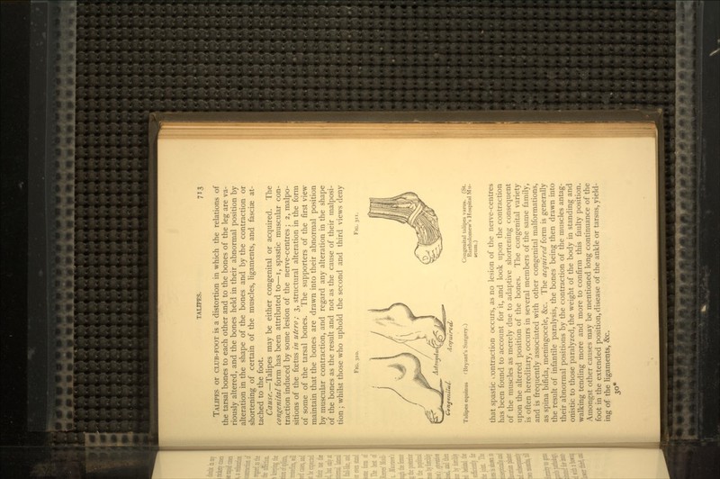 TALIPES or CLUB-FOOT is a distortion in which the relations of the tarsal bones to each other and to the bones of the leg are va- riously altered, and the bones held in their abnormal position by alteration in the shape of the bones and by the contraction or shortening of certain of the muscles, ligaments, and fasciae at- tached to the foot. Cause.—Talipes may be either congenital or acquired. The congenital form has been attributed to—i, spastic muscular con- traction induced by some lesion of the nerve-centres; 2, malpo- sitions of the foetus in utero; 3, structural alteration in the form of some of the tarsal bones. The supporters of the first view maintain that the bones are drawn into their abnormal position by muscular contraction, and regard any alteration in the shape of the bones as the result and not as the cause of their malposi- tion ; whilst those who uphold the second and third views deny FIG. 310. FIG. 311. Astnwalu Acquired, Talipes equinus (Bryant's Surgery.) Congenital talipes varus. (St. Bartholomew's Hospital Mu- seum.) that spastic * contraction occurs, as no lesion of the nerve-centres has been found to account for it, and look upon the contraction of the muscles as merely due to adaptive shortening consequent upon the altered position of the bones. The congenital variety is often hereditary, occurs in several members of the same family, and is frequently associated with other congenital malformations, as spina bifida, meningocele, &c. The acquired form is generally the result of infantile paralysis, the bones being then drawn into their abnormal positions by the contraction of the muscles antag- onistic to those paralyzed, the weight of the body in standing and walking tending more and more to confirm this faulty position. Amongst other causes may be mentioned long continuance of the foot in the extended position, disease of the ankle or tarsus, yield- ing of the ligaments, &c. 30*