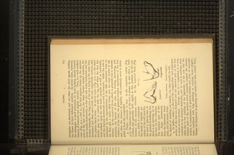 astragalus are shortened, and are often the chief agents holding the bones in their deformed position. In severe cases, however, the astragalus is itself deformed, its head looking almost inwards instead of forwards and slightly inwards. Thus, in a well-marked case (Fig. 312, A and B), the heel appears drawn up, the anterior part of the foot inverted, the inner border turned upwards, the outer border downwards, so that the sole looks backwards and the dorsum forwards, the long axis of the foot being at the same time shortened and bent upon itself, the sole unnaturally concave, and the plantar fascia tense. In severe cases (Fig. 312, c), the inner border may be in contact with the leg, and when the foot has been walked upon the sole looks upwards as well as backwards, and the dorsum downwards as well as forwards ; whilst the sole is narrowed by the approximation of the fifth metatarsal bone to the first, and a bursa often forms over the outer border of the dorsum. In the acquired form, which is generally due to infantile paralysis, the history of the case, the wasting, shortening, and coldness of the limb, the general rounded appearance of the foot and often the absence of rigidity, will commonly serve to distin- guish it from the congenital. 3. Talipes calcaneus is rare. In the congenital variety (Fig. 313) the anterior part of the foot is drawn up and often a little everted, and generally held rigidly in this position by the con- traction of the extensor muscles. In the acquired form (Fig. 313), which is commonly FIG. 313. the result of infantile pa- ralysis of the calf muscles, the heel is placed first on the ground in walking, but there is no drawing up of the foot by the extensors. The anterior part of the . foot drops downwards from the transverse tarsal joint, and the tendo Achil- TaliPes ^Icaneus. (Bryant's Surgery.) Us, instead of standing out tensely, can often hardly be felt. 4. In talipes valgus or flat foot the longitudinal and transverse arches of the foot are flattened and the anterior part of the foot is more or less everted. Though rare as a congenital, it is very common as an acquired deformity, and as such is, perhaps, most often due to the yielding of the ligaments of the sole and the relaxed state of the muscles which normally support the plantar arches, in consequence of general debility and want of muscular tone, combined with long standing or carrying heavy weights. Hence its frequency in growing and under-fed lads, errand boys,