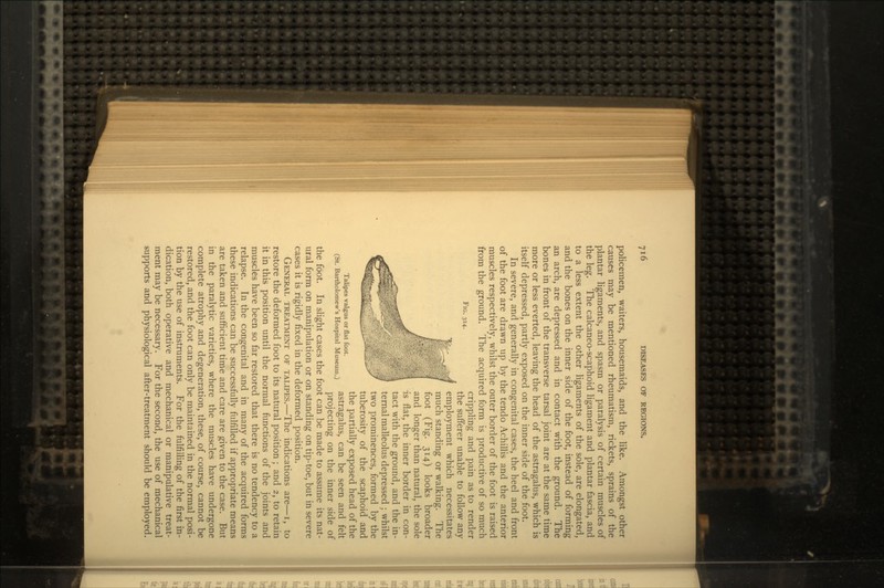 policemen, waiters, housemaids, and the like. Amongst other causes may be mentioned rheumatism, rickets, sprains of the plantar ligaments, and spasm or paralysis of certain muscles of the leg. The calcaneo-scaphoid ligament and plantar fascia, and to a less extent the other ligaments of the sole, are elongated, and the bones on the inner side of the foot, instead of forming an arch, are depressed and in contact with the ground. The bones in front of the transverse tarsal joint are at the same time more or less everted, leaving the head of the astragalus, which is itself depressed, partly exposed on the inner side of the foot. In severe, and generally in congenital cases, the heel and front of the foot are drawn up by the tendo Achillis and the anterior muscles respectively, whilst the outer border of the foot is raised from the ground. The acquired form is productive of so much crippling and pain as to render the sufferer unable to follow any employment which necessitates much standing or walking. The foot (Fig. 314) looks broader and longer than natural, the sole is flat, the inner border in con- tact with the ground, and the in- ternal malleolus depressed; whilst two prominences, formed by the tuberosity of the scaphoid and the partially exposed head of the Talipes valgus or flat foot. , J r, -, c ,. (St. Bartholomew's Hospital Museum.) astragalus, can be seen and felt projecting on the inner side of the foot. In slight cases the foot can be made to assume its nat- ural form on manipulation or on standing on tip-toe, but in severe cases it is rigidly fixed in the deformed position. GENERAL TREATMENT OF TALIPES.—The indications are—i, to restore the deformed foot to its natural position; and 2, to retain it in this position until the normal functions of the joints and muscles have been so far restored that there is no tendency to a relapse. In the congenital and in many of the acquired forms these indications can be successfully fulfilled if appropriate means are taken and sufficient time and care are given to the case. But in the paralytic varieties, where the muscles have undergone complete atrophy and degeneration, these, of course, cannot be restored, and the foot can only be maintained in the normal posi- tion by the use of instruments. For the fulfilling of the first in- dication, both operative and mechanical or manipulative treat- ment may be necessary. For the second, the use of mechanical supports and physiological after-treatment should be employed.