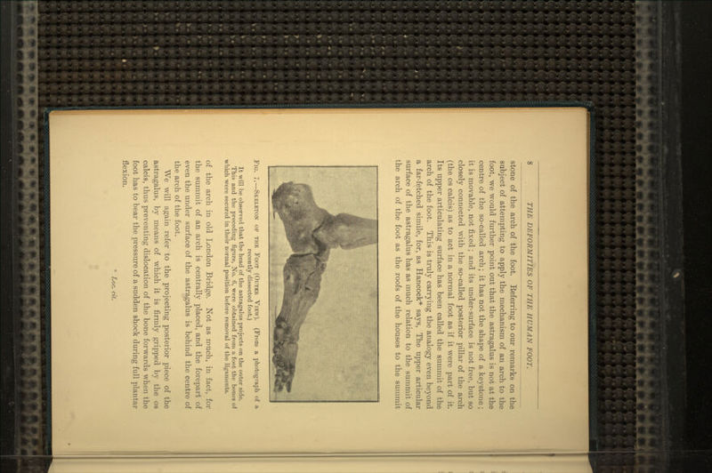 stone of the arch of the foot. Eeferring to our remarks on the subject of attempting to apply the mechanism of an arch to the foot, we would further point out that the astragalus is not at the centre of the so-called arch; it has not the shape of a keystone; it is movable, not fixed ; and its under-surface is not free, but so closely connected with the so-called posterior pillar of the arch (the os calcis) as to act in a normal foot as if it were part of it. Its upper articulating surface has been called the summit of the arch of the foot. This is truly carrying the analogy even beyond a far-fetched simile, for, as Hancock* says, The upper articular surface of the astragalus has as much relation to the summit of the arch of the foot as the roofs of the houses to the summit Fig. 7.—Skeleton op the Foot (Outer View). (From a photograph of a recently dissected foot.) It will be observed that the head of the astragalus projects on the outer side. This and the preceding figure, No. 6, were obtained from a foot the bones of which were secured in their normal position before removal of the ligaments. of the arch in old London Bridge. Not as much, in fact, for the summit of an arch is centrally placed, and the forepart of even the under surface of the astragalus is behind the centre of the arch of the foot. We will again refer to the projecting posterior piece of the astragalus, by means of which it is firmly gripped by the os calcis, thus preventing dislocation of the bone forwards when the foot has to bear the pressure of a sudden shock during full plantar flexion. * Loc. cit.