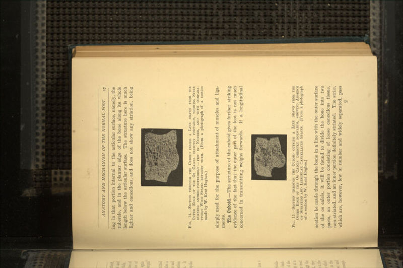 ing in that portion internal to the articular surface, namely, the tubercle, and in the plantar edge of the bone along its whole length below the articular surface. The structure here is much lighter and cancellous, and does not show any striation, being mmmmmmmm 1 Fig. 14.—Section through the Cuboid inside a Line drawn from the Outer Edge op the Os Calcis directly forwards, showing Strl*: running antero-posteriorly — few in Number, and with compara- tively Wide Spaces between them. (From a photograph of a section made by W. Kent Hughes.) simply used for the purpose of attachment of muscles and liga- ments. The Cuboid.—The structure of the cuboid gives further striking evidence of the fact that the outer patt of the foot is not much concerned in transmitting weight forwards. If a longitudinal ^T1^! Fig. 15.—Section through the Cuboid outside a Line drawn from the Outer Edge of the Os Calcis directly forwards, showing Absence of Striation and Irregular Cancellated Spaces. (From a photograph of a section by W. Kent Hughes.) section be made through the bone in a line wTith the outer surface of the os calcis, it will be found to divide the bone into two parts, an outer portion consisting of loose cancellous tissue, non-striated, and an inner portion definitely striated. The striae, which are, however, few in number and widely separated, pass 2