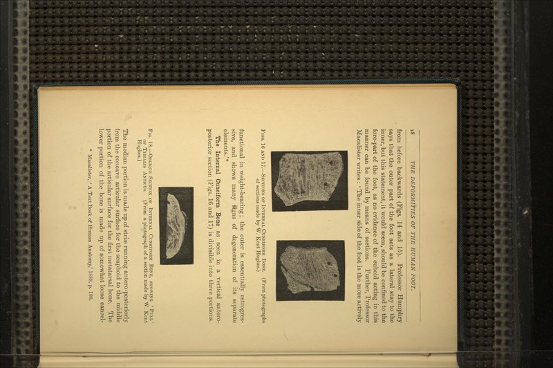 from before backwards (Figs. 14 and 15). Professor Humphry says that the outer part of the foot acts as a lateral stay to the inner, but this statement, it would seem, should be confined to the fore-part of the foot, as no evidence of the cuboid acting in this manner can be found by means of sections. Further, Professor Macalister writes : ' The inner side of the foot is the more actively Figs. 16 and 17.—Sections of Internal Cuneiform Bone. (From photographs of sections made by W. Kent Hughes.) functional in weight-bearing; the outer is essentially retrogres- sive, and shows many signs of degeneration of its separate elements.'* The Internal Cuneiform Bone as seen in a vertical antero- posterior section (Figs. 16 and 17) is divisible into three portions. Fig. 18.—Oblique Section of Internal Cuneiform Bone, showing 'Pull' of Tibialis Anticus. (From a photograph of a section made by W. Kent Hughes.) The median portion is made up of striae running antero-posteriorly from the concave articular surface for the scaphoid to the middle portion of the articular surface for the first metatarsal bone. The lower portion of the bone is made up of somewhat loose cancel- * Macalister, ' A Text Book of Human Anatomy,' 1S89, p. 198.