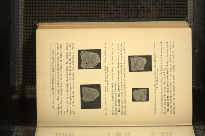 lous tissue. The upper portion is also honeycombed, but denser than the lower, though there is no evidence of definite stria- tion. Sawing the bone through obliquely from the antero-inferior angle to the postero-superior, we divide it in the line of the ' pull' of the tibialis anticus tendon, the direction of which Fig. 19.—Sections of External Cuneiform Bone. (From photograph of sections by W. Kent Hughes.) (Fig. 18) is marked by striae running from the insertion of the tendon upwards and outwards. The Middle and External Cuneiform Bones show a similar structure upon being sawn antero-posteriorly in a vertical direc- tion; the upper three-fourths of each bone is marked by definite Fig. 20.—Sections of Middle Cuneiform Bone. (From photograph of sections by W. Kent Hughes.) striae running antero-posteriorly ; the lower fourth is composed of loose cancellous tissue (Figs. 19 and 20). The Base of the Fifth Metatarsal Bone.—Lastly, as anatomical evidence that the outer part of the front of the foot acts as a lateral stay to the inner, we refer to Figs. 21 and 22, which