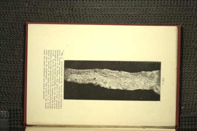 FIG. I. Pig. I. Arteriosclerosis of the thoracic and abdomina, aorta, showing irregular nodules, atheromatous plaquesl denudation of the intima, thin plates of bone scattered throughout with spicules extending into the lumen of the vessel. Note the contraction of the openings of the large branches, the rough appearance of the aorta and the greater degree of sclerosis of the upper two-thirds, i. e., of the aorta above the diaphragm. This aorta in the recent state was much thickened and almost inelastic.