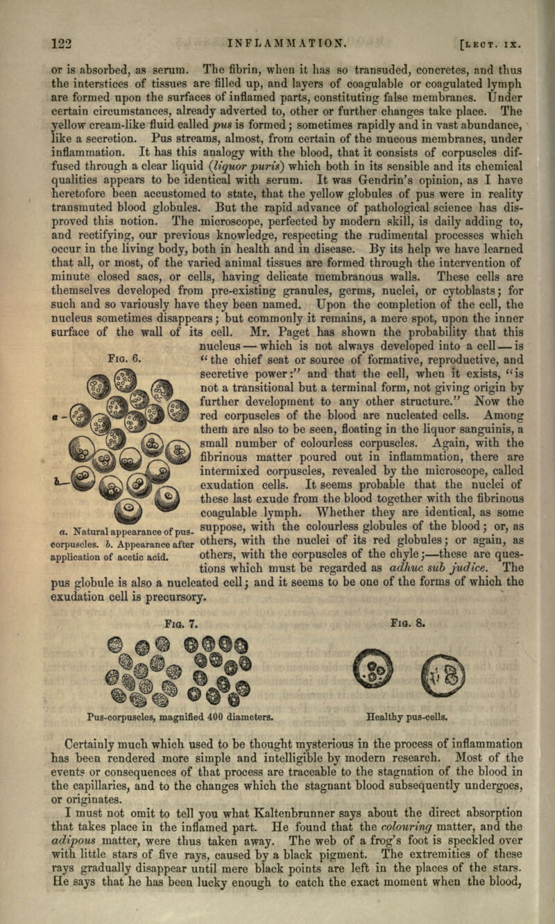 or is absorbed, as serum. The fibrin, when it has so transuded, concretes, and thus the interstices of tissues are filled up, and layers of coagulable or coagulated lymph are formed upon the surfaces of inflamed parts, constituting false membranes. Under certain circumstances, already adverted to, other or further changes take place. The yellow cream-like fluid called pus is formed; sometimes rapidly and in vast abundance, like a secretion. Pus streams, almost, from certain of the mucous membranes, under inflammation. It has this analogy with the blood, that it consists of corpuscles dif- fused through a clear liquid (liquor puris) which both in its sensible and its chemical qualities appears to be identical with serum. It was Gendrin's opinion, as I have heretofore been accustomed to state, that the yellow globules of pus were in reality transmuted blood globules. But the rapid advance of pathological science has dis- proved this notion. The microscope, perfected by modern skill, is daily adding to, and rectifying, our previous knowledge, respecting the rudimental processes which occur in the living body, both in health and in disease. By its help we have learned that all, or most, of the varied animal tissues are formed through the intervention of minute closed sacs, or cells, having delicate membranous walls. These cells are themselves developed from pre-existing granules, germs, nuclei, or cytoblasts; for such and so variously have they been named. Upon the completion of the cell, the nucleus sometimes disappears} but commonly it remains, a mere spot, upon the inner surface of the wall of its cell. Mr. Paget has shown the probability that this nucleus — which is not always developed into a cell — is  the chief seat or source of formative, reproductive, and secretive power: and that the cell, when it exists, is not a transitional but a terminal form, not giving origin by further development to any other structure. Now the red corpuscles of the blood are nucleated cells. Among them are also to be seen, floating in the liquor sanguinis, a small number of colourless corpuscles. Again, with the fibrinous matter poured out in inflammation, there are intermixed corpuscles, revealed by the microscope, called exudation cells. It seems probable that the nuclei of these last exude from the blood together with the fibrinous ^^ coagulable lymph. Whether they are identical, as some «. Natural apTTrance of pus- suPPose> with the colourless globules of the blood; or, as corpuscles. 6. Appearance after others, with the nuclei of its red globules; or again, as application of acetic acid. others, with the corpuscles of the chyle;—these are ques- tions which must be regarded as adhuc sub judice. The pus globule is also a nucleated cell; and it seems to be one of the forms of which the exudation cell is precursory. FIG. 6. FIG. 7. Fio. 8. Pus-corpuscles, magnified 400 diameters. Healthy pus-cells. Certainly much which used to be thought mysterious in the process of inflammation has been rendered more simple and intelligible by modern research. Most of the event? or consequences of that process are traceable to the stagnation of the blood in the capillaries, and to the changes which the stagnant blood subsequently undergoes, or originates. I must not omit to tell you what Kaltenbrunner says about the direct absorption that takes place in the inflamed part. He found that the colouring matter, and the adipous matter, were thus taken away. The web of a frog's foot is speckled over with little stars of five rays, caused by a black pigment. The extremities of these rays gradually disappear until mere black points are left in the places of the stars. He says that he has been lucky enough to catch the exact moment when the blood,