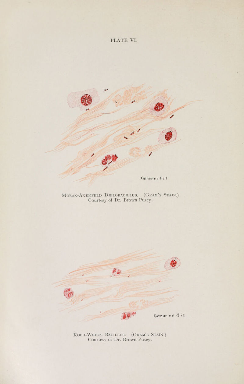 >>* / Katharrn« Hill MORAX-AXENFELD DiPLOBACILLXJS. (GRAM'S StAIX.) Courtesy of Dr. Brown Pusey. 3.^ I\atharinir H ill Koch-Weeks Bacillus. (Gram's Stain.) Courtesy of Dr. Brown Pusey.