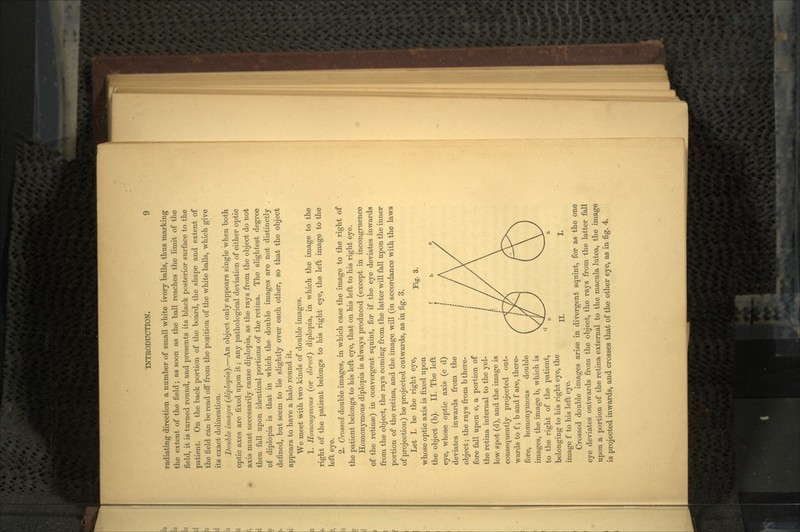 radiating direction a number of small white ivory balls, thus marking the extent of the field; as soon as the ball reaches the limit of the field, it is turned round, and presents its black posterior surface to the patient. On the back portion of the board, the shape and extent of the field can be read off from the position of the white balls, which give its exact delineation. Double images (diplopia).—An object only appears single when both optic axes are fixed upon it; any pathological deviation of either optic axis must necessarily cause diplopia, as the rays from the object do not then fall upon identical portions of the retina. The slightest degree of diplopia is that in which the double images are not distinctly defined, but seem to lie slightly over each other, so that the object appears to have a halo round it. We meet with two kinds of double images. 1. Homonymous (or direct) diplopia, in which the image to the right of the patient belongs to his right eye, the left image to the left eye. 2. Crossed double images, in which case the image to the right of the patient belongs to his left eye, that on his left to his right eye. Homonymous diplopia is always produced (except in incongruence of the retinae) in convergent squint, for if the eye deviates inwards from the object, the rays coming from the latter will fall upon the inner portion of the retina, and the image will (in accordance with the laws of projection) be projected outwards, as in fig. 3. Let I. be the right eye, p. 3 whose optic axis is fixed upon the object (b). II. The left eye, whose optic axis (c d) deviates inwards from the object; the rays from b there- fore fall upon e, a portion of the retina internal to the yel- low spot (d), and the image is consequently projected out- wards to f; b and f are, there- fore, homonynaous double images, the image b, which is to the right of the patient, belonging to his right eye, the image f to his left eye. Crossed double images arise in divergent squint, for as the one eye deviates outwards from the object, the rays from the latter fall upon a portion of the retina external to the macula lutea, the image is projected inwards, and crosses that of the other eye, as in fig. 4.
