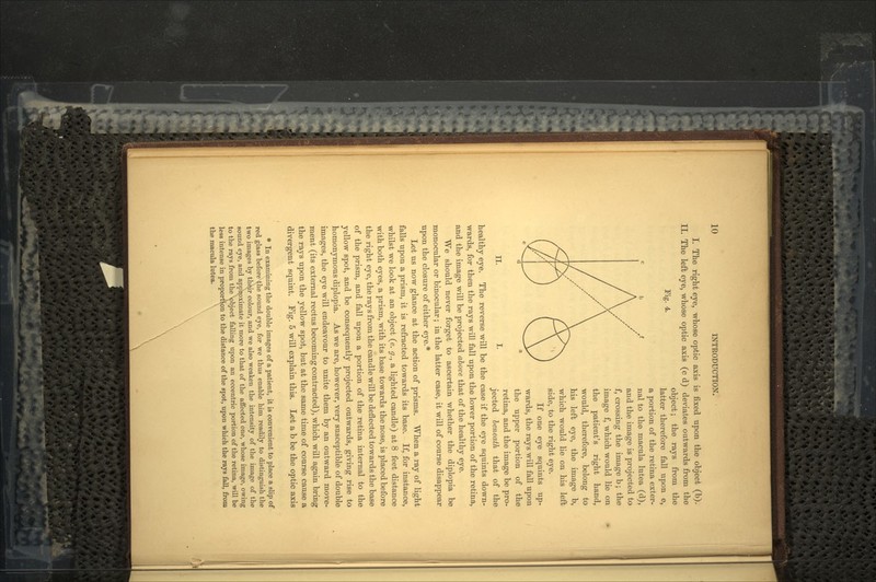 I. The right eye, whose optic axis is fixed upon the object (b). II. The left eye, whose optic axis (c d) deviates outwards from the object ; the rays from the fall Fig. 4. II. I. latter therefore a upon e, a portion of the retina exter- nal to the macula lutea (d), and the image is projected to f, crossing the image b ; the image f, which would lie on the patient's right hand, would, therefore, belong to his left eye, the image b, which would lie on his left side, to the right eye. If one eye squints up- wards, the rays will fall upon the upper portion of the retina, and the image be pro- jected beneath that of the healthy eye. The reverse will be the case if the eye squints down- wards, for then the rays will fall upon the lower portion of the retina, and the image will be projected above that of the healthy eye. We should never forget to ascertain whether the diplopia be monocular or binocular ; in the latter case, it will of course disappear upon the closure of either eye.* Let us now glance at the action of prisms. When a ray of light falls upon a prism, it is refracted towards its base. If, for instance, whilst we look at an object (e. g., a lighted candle) at 8 feet distance with both eyes, a prism, with its base towards the nose, is placed before the right eye, the rays from the candle will be deflected towards the base of the prism, and fall upon a portion of the retina internal to the yellow spot, and be consequently projected outwards, giving rise to homonymous diplopia. As we are, however, very susceptible of double images, the eye will endeavour to unite them by an outward move- ment (its external rectus becoming contracted), which will again bring the rays upon the yellow spot, but at the same time of course cause a divergent squint. Fig. 5 will explain this. Let a b be the optic axis * In examining the double images of a patient, it is convenient to place a slip of red glass before the sound eye, for we thus enable him readily to distinguish the two images by thi\ir colour, and we also weaken the intensity of the image of the sound eye, and approximate it more to that of the affected one, whose image, owing to the rays from the ^object falling upon an eccentric portion of the retina, will be less intense in proportion to the distance of the spot, upon which the rays fall, from the macula lutea.