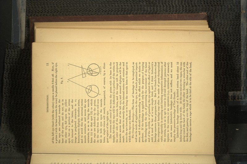 Fig. 5. of the left eye fixed (with the other) upon a candle 8 feet off. Now, if a prism (with its base towards the nose) be placed before the right eye, the rays are refracted towards the base of the prism and do not, as in the other eye, fall upon the yellow spot, but on a portion of the retina (d) internal to the latter, and the image is projected outwards to e; homonymous diplopia therefore arises, and to avoid this the external rectus muscle contracts and moves the eye outwards, so as to bring the macula lutea (c) to that spot (d) to which the rays are deflected by the prism. As the rays from the object will now fall in both eyes upon the macula lutea, single vision will result, accompanied, of course, by a diver- gent squint of the right eye. The reverse will occur if we turn the prism with its base to the temple, for then the rays will be deflected to a portion of the retina to the outer side of the macula lutea, and the image will be projected inwards across that of the left eye, and crossed diplopia will be the result. In order to remedy this, the internal rectus will contract and move the eye inwards, so as to bring the macula lutea to that spot to which the rays are deflected. The Compress Bandage.—The form of bandage to be employed, as well as its mode of application to the eye, is of much practical import- ance, and it should vary according to the effect which we desire to produce. If the bandage is applied only for the purpose of keeping the dressing upon the eye, of preventing the movement of the latter and of the eyelids, or of guarding the eye against the effect of light or cold, it need be but of a very simple kind, and I think Liebreich's bandage answers these purposes best. But Von Graefe has shown that the compress and bandage may often be made of great therapeutical value, especially in arresting and limiting suppurative inflammation of the cornea, such as is apt to occur in old and decrepid persons after injuries to the cornea, or an operation (e.g., extraction of cataract). In such cases Liebreich's bandage does not suffice, and we must employ the pressure-bandage of Von Graefe. Liebreich's bandage consists of a knitted cotton band about 12 inches long and 2^ inches wide. At the one end are two tapes, the one going round the back of the head, the other forming a cross-bar with the first, and passing over the top of the head. The other end of the bandage also carries a tape which is to be tied at the side of the head,