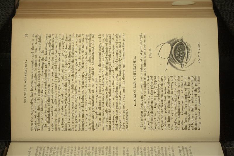 when the conjunctiva has become more vascular and there is an effusion of serum into it, scarification is often of much benefit The incision should be somewhat deeper than in purulent ophthal- mia, and the bleeding be kept up by kneading the lids. In order to hasten the vascularization and the breaking down and elimination of the fibrinous infiltration of the conjunctiva, the system should be got as quickly as possible under the influence of mercury, so that salivation may be produced in the course of 30 40 hours. The mercury may either be administered internally in the form of calomel and opium (calomel gr. ss—gr. j every 2—3 hours) in doses varying with the age of the patient, or from 3ss— 3j of the mercurial ointment should be rubbed in three times daily. In very severe cases, the rapidity with which the fibrinous infiltra- tion pervades the conjunctiva is often so great that the cornea becomes implicated and the eye lost, before the system can be brought under the influence of mercury. Moreover, the free use of this remedy is often contra-indicated by the very feeble and cachec- tic condition of the patient, in which case tonics, more especially quinine and preparations of iron, should be administered, and the patient be placed on a generous diet. When the disease is passing over into the second stage, and is assuming more and more the character of purulent ophthalmia, we must gradually commence the use of the mitigated nitrate of silver. But at first the cauterization must be employed with great care and discretion, as there is always the risk of causing a relapse if it be used with too great a freedom at once. Should symptoms of stasis reappear the cauterization must be immediately abandoned until these have passed away, and the disease again assumes the puru- lent character. 7._GRANULAR OPHTHALMIA. It has been already mentioned that in catarrhal and purulent oph- thalmia, the papillae of the conjunctiva are often much swollen and hypertrophied, forming more or less prominent elevations on the palpebral conjunctiva. [Fig. 19.] They appear in the form of bright or bluish-red, vel- vety, succulent elevations, which have no distinct pedicle, but seem to pass over into the tissue of the conjunc- tiva. They are ranged in rows, and are of course confined to that portion of the conjunctiva which contains papillae. Commencing at about ^ a line from the free margin of the lid, they extend slightly beyond its tar- sal border; their sides are generally flattened, on account of the papillae being pressed against each other. After T. w. Jones.]