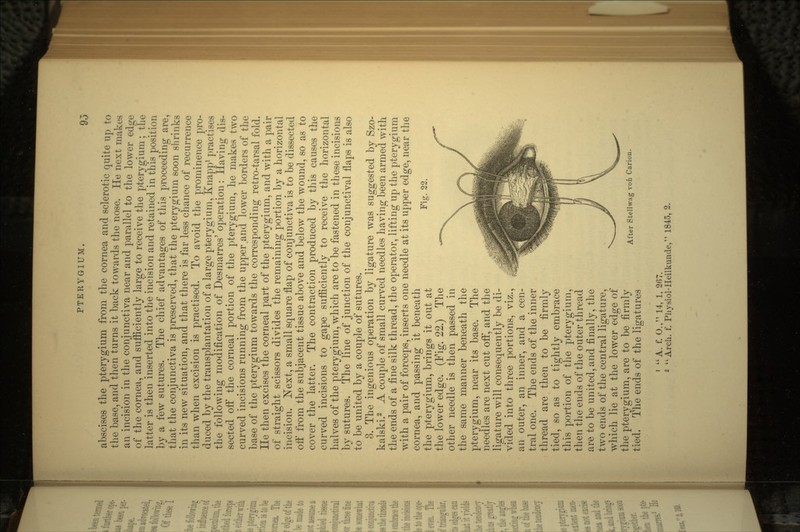 abscises the pterygium from the cornea and sclerotic quite up to the base, and then turns it back towards the nose. He next makes an incision in the conjunctiva near and parallel to the lower edo-e of the cornea, and sufficiently large to receive the pterygium; the latter is then inserted into the incision and retained in this position by a few sutures. The chief advantages of this proceeding are, that the conjunctiva is preserved, that the pterygium soon shrinks' in its new situation, and that there is far less chance of recurrence than when excision is practised. To avoid the prominence pro- duced by the transplantation of a large pterygium, Knapp1 practises the following modification of Desmarres' operation: Having dis- sected off the corneal portion of the pterygium, he makes two curved incisions running from the upper .and lower borders of the base of the pterygium towards the corresponding retro-tarsal fold. He then excises the corneal part of the pterygium, and with a pair of straight scissors divides the remaining portion by a horizontal incision. Next, a small square flap of conjunctiva is to be dissected off from the subjacent tissue above and below the wound, so as to cover the latter. The contraction produced by this causes the curved incisions to gape sufficiently to receive the horizontal halves of the pterygium, which are to be fastened in these incisions by sutures. The line of junction of the conjunctival flaps is also to be united by a couple of sutures. 3. The ingenious operation by ligature was suggested by Szo- kalski.2 A couple of small curved needles having been armed with the ends of a fine silk thread, the operator, lifting up the pterygium with a pair of forceps, inserts one needle at its upper edge, near the cornea, and passing it beneath the pterygium, brings it out at the lower edge. (Fig. 22.) The other needle is then passed in the same manner beneath the pterygium, near its base. The needles are next cut off, and the ligature will consequently be di- vided into three portions, viz., an outer, an inner, and a cen- tral one. The ends of the inner thread are then to be firmly tied, so as to tightly embrace this portion of the pterygium, then the ends of the outer thread are to be united, and finally, the two ends of the central ligature, which lie at the lower edge of the pterygium, are to be firmly tied. The ends of the ligatures Fig. 22. After Stellwag von Carioii. ' A. f. O., 14, 1, 2fi7.