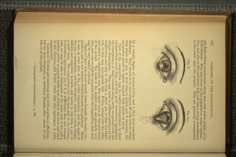 red, flesh-colored excrescences, being met with either singly, or in little clusters. They may occur on the palpebral or ocular conjunc- tiva, and also on the semi-lunar fold, and bear a strong resemblance to the warts upon the prepuce. They are generally accompanied [Fig. 31. Fig. 32.] by a certain degree of conjunctivitis, and a thin muco-purulent discharge. They should be at once snipped off with scissors before they attain any size, or have time to spread, and if necessary, the cut portion should be lightly touched with nitrate of silver. Cysts of the conjunctiva may be readily distinguished by their circumscribed round form, and their pink, translucent appearance, the transparency of their contents being easily recognized with the oblique illumination. They may occur in different portions of the conjunctiva, and vary in size from a small pea to that of a hazel- nut, or they may even exceed this. If they extend into the orbit, and attain a considerable size, they cause more or less protrusion of the eyeball. The walls of the smaller cysts are generally very thin, and only so slightly connected with the conjunctiva that they may be very readily removed. Cysticerci have been found several times beneath the ocular con- junctiva, and in one instance (Sichel) beneath the palpebral. There is seen at some part of the ocular conjunctiva, near the angle of the eye, a transparent, cyst-like elevation, which is round, sharply defined, and somewhat movable, and varies in size from a pea to a small bean. The conjunctiva over the cyst, and in its vicinity, is somewhat hyperaemic, but if it is sufficiently thin and transpa- rent, we may be able to distinguish at the outer wall of the cyst a peculiar yellow or grayish-white spot, which is the head and neck of the entozoon, and Sichel1 states that this appearance is quite characteristic. CANCEROUS TUMORS are sometimes met with as primary affections, but far more frequently as secondary diseases, after cancer of the lids or of the eyeball. Iconograpliie Ophthalmologique, p. 702.