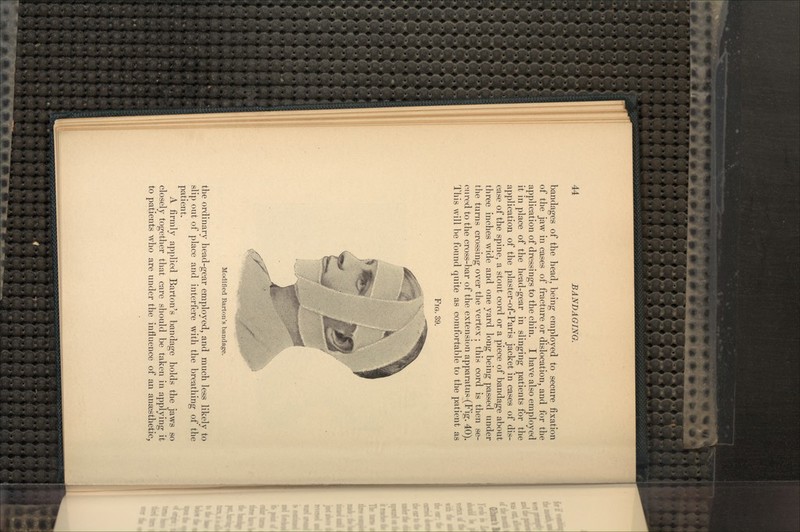 bandages of the head, being employed to secure fixation of the jaw in cases of fracture or dislocation, and for the application of dressings to the chin. I have also employed it in place of the head-gear in slinging patients for the application of the plaster-of-Paris jacket in cases of dis- ease of the spine, a stout cord or a piece of bandage about three inches wide and one yard long being passed under the turns crossing over the vertex; this cord is then se- cured to the cross-bar of the extension apparatus (Fig. 40). This will be found quite as comfortable to the patient as FIG. 39. Modified Barton's bandage. the ordinary head-gear employed, and much less likely to slip out of place and interfere with the breathing of the patient. A firmly applied Barton's bandage holds the jaws so closely together that care should be taken in applying it to patients who are under the influence of an anaesthetic,