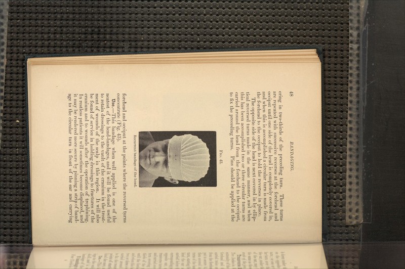 ering in two-thirds of the preceding turn. These turns are repeated with successive reverses at the forehead and occiput until one side of the head is completely covered in, and when this is accomplished a circular turn is made from the forehead to the occiput to hold the reverses in place. The opposite side of the head is next covered in by ellip- tical reversed turns made in the same manner, and when this has been accomplished two or three circular turns are carried around the head from the forehead to the occiput, to fix the preceding turns. Pins should be applied at the FIG. 43. Recurrent bandage of the head. forehead and occiput at the points where the reversed turns concentrate (Fig. 43). Use.—This bandage when well applied is one of the neatest of the head-bandages, and it will be found useful to retain dressings to the vault of the cranium in the treat- ment of wounds of the scalp in this region. It will also be found of service in holding dressings to fractures of the cranium and to wounds after the operation of trephining. In restless patients it will sometimes become displaced, and it may be rendered more secure by pinning a strip of band- age to the circular turn in front of the ear and carrying