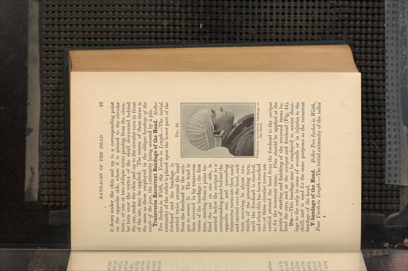 FIG. 44. it down under the chin and up to a corresponding point on the opposite side, where it is pinned to the circular turn ; or one or two oblique turns passing from the circu- lar turn over the vertex of the skull downward behind the ear, under the chin and up to the circular turn in front of the ear, may be applied. The course of these turns is the same as those employed in the oblique bandage of the angle of the jaw, the extremity being secured by a pin. Transverse Recurrent Bandage of the Head. Roller Two Inches in Width, Sip Yards in Length.—The initial extremity of the roller is placed upon the lower part of the forehead and the bandage is carried twice around the head from the forehead to the occi- put to secure it. The head is then covered in by transverse turns of the bandage ; the first turn, starting from a point be- hind the ear on one side, is carried below the occiput to a corresponding point behind the opposite ear, and ascending transverse turns are then made and carried over the head, each turn covering in about two- thirds of the preceding turn, until the forehead is reached, and when this has been reached two or three circular turns are carried around the head from the forehead to the occiput to fix the recurrent turns. Pins should be applied at the points of starting and finishing of the reversed turns be- hind the ears, and at the occiput and forehead (Fig. 44). Use.—This bandage may be employed to secure dress- ings to the scalp in cases of wounds or in injuries to the skull, and is used for the same purposes as the recurrent bandage of the head. V-bandage of the Head. Roller Two Inches in Width, Four Yards in Length.—The initial extremity of the roller 4 Transverse recurrent bandage ol the head.