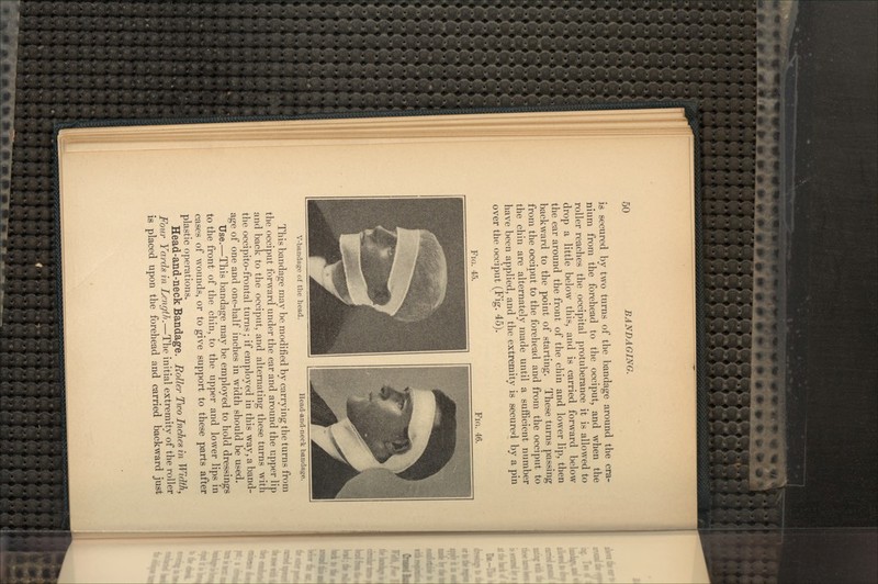 is secured by two turns of the bandage around the cra- nium from the forehead to the occiput, and when the roller reaches the occipital protuberance it is allowed to drop a little below this, and is carried forward below the ear around the front of the chin and lower lip, then backward to the point of starting. These turns passing from the occiput to the forehead and from the occiput to the chin are alternately made until a sufficient number have been applied, and the extremity is secured by a pin over the occiput (Fig. 45). FIG. 45. FIG. 46. V-bandage of the head. Head-and-neck bandage. This bandage may be modified by carrying the turns from the occiput forward under the ear and around the upper lip and back to the occiput, and alternating these turns with the occipito-frontal turns; if employed in this way, a band- age of one and one-half inches in width should be used. Use.—This bandage may be employed to hold dressings to the front of the chin, to the upper and lower lips in cases of wounds, or to give support to these parts after plastic operations. Head-and-neck Bandage. Roller Two Inches in Width, Four Yards in Length.—The initial extremity of the roller is placed upon the forehead and carried backward just