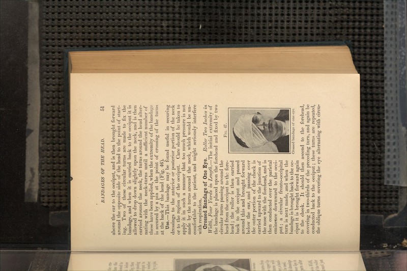 above the ear to the occiput, and is then brought forward around the opposite side of the head to the point of start- ing. Two of these circular turns are made to fix the bandage, and when it is carried back to the occiput it is allowed to drop down slightly upon the neck, and is then carried around the neck, the turns around the head alter- nating with the neck-turns until a sufficient number of these have been applied, when the extremity of the bandage is secured by a pin at the point of crossing of the turns at the back of the head (Fig. 46). Use.—This bandage may be found useful in securing dressings to the anterior or posterior portion of the neck or to the region of the occiput. Care should bo taken to apply it in such a manner that too much pressure is not made by the turns around the neck, which would be un- comfortable to the patient, and might seriously interfere with respiration. Crossed Bandage of One Eye. Roller Two Inches in Width, Four Yards in Length.—The initial extremity of the bandage is placed upon the forehead and fixed by two circular turns passing around the head from the occiput to the fore- head ; the roller is then carried back to the occiput and passed around this and brought forward below the ear, and passing over the outer portion of the cheek is carried upward to the junction of the nose with the forehead, and is then conducted over the parietal eminence downward to the occi- put; a circular fronto-occipital turn is next made, a-nd when the bandage is brought back to the oc- ciput it is brought forward again to the cheek. It should then ascend to the forehead, covering in two-thirds of the preceding turn, and again be conducted back to the occiput; these turns are repeated, the oblique turns covering the eye alternating with circu- FIG. 47. Crossed bandage of one eye.