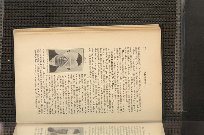 lar turns around the head until the eye is completely en- closed (Fig. 47). and the bandage is finished by making a circular turn about the head and introducing a pin to secure its extremity. It will be found more comfortable to the patient to include in the turns of the bandage the ear on the same side on which the eye is covered. Use.—This bandage will be found useful in retaining dressings to one eye. It will be more comfortable to the patient if a flannel roller be used to apply this bandage, as well as the bandage which includes both eyes. Crossed Bandage of Both Eyes. Roller Two Inches in Width, Six Yards in Length.—The initial extremity of the roller is placed upon the forehead and secured by two circular turns of the bandage passing around the head from the forehead to the occiput; the roller is then carried downward behind the occiput and brought forward below the ear to the upper portion of the cheek ; it is then car- ried upward to the junction of the nose with the forehead and conducted over the parietal eminence to the occiput ; a circular turn is now made around the head from the occiput to the forehead, and the roller is carried from the occiput over the parietal eminence of the opposite side for- ward to the junction of the- nose with the forehead, then downward over the eye and outer portion of the cheek below the ear and back to the occiput; a circular turn around the head is next made, and this is followed by a repetition of the pre- ^^^^^ f^k vious turns, ascending over one eye, Hjh \ fl descending over the other eye, each turn alternating with a circular turn around the head. These turns Fio. 48. Crossed bandage of both eyes. are repeated until both eyes are covered in, and the band- age is finished by making a circular turn around the head, the extremity being secured by a pin (Fig. 48). In this bandage both ears may be covered in or left uncovered.