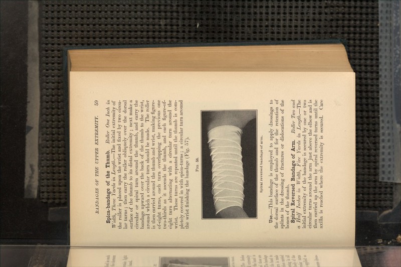 Spica-bandage of the Thumb. Roller One Inch in Width, Three Yards in Length.—The initial extremity of the roller is placed upon the wrist and fixed by two circu- lar turns; then carry the roller obliquely over the dorsal surface of the thumb to its distal extremity ; next make a circular or spiral turn around the thumb, and carry the bandage upward over the back of the thumb to the wrist, around which a circular turn should be made. The roller is then carried around the thumb and wrist, making figure- of-eight turns, each turn overlapping the previous one two-thirds as it ascends the thumb, and each figure-of- eight turn alternating with a circular turn around the wrist. These turns are repeated until the thumb is com- pletely covered in with spica-turns ; a circular turn around the wrist finishing the bandage (Fig. 57). FIG, 58. Spiral reversed bandage of arm. Use.—This bandage is employed to apply dressings to the dorsal surface of the thumb and for the retention of splints in the dressing of fractures or dislocations of the bones of the thumb. Spiral Reversed Bandage of Ann. Roller Two and a Half Inches in Width, Five Yards in Length.—The initial extremity of the bandage is secured by one or two circular turns around the arm just above the elbow and is then carried up the arm by spiral reversed turns until the axilla is reached where the extremity is secured. Care