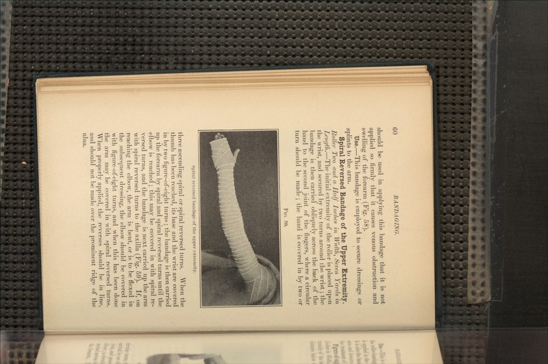 should be used in applying this bandage that it is not applied so firmly that it causes venous obstruction and swelling of the forearm (Fig. 58). Use.—This bandage is employed to secure dressings or splints to the arm. Spiral Reversed Bandage of the Upper Extremity. Roller Two and a Half Inches in Width, Seven Yards in Length.—The initial extremity of the roller is placed upon the wrist, and secured by two turns around the wrist; the bandage is then carried obliquely across the back of the hand to the second joint of the fingers, where a circular turn should be made; the hand is covered in by two or Flfi. 59. Spiral reversed bandage of the upper extremity. three ascending spiral or spiral reversed turns. When the thumb has been reached, its base and the wrist are covered in by two figure-of-eight turns; the bandage is then carried up the forearm by spiral and spiral reversed turns until the elbow is reached; this may be covered in with spiral re- versed turns, and the bandage is next carried up the arm with spiral reversed turns to the axilla (Fig. 59). If, on reaching the elbow, the arm is bent, or is to be flexed in the subsequent dressing, the elbow should be covered in with figure-of-eight turns, and when this has been done the arm may be covered in with spiral reversed turns. When properly applied, the reverses should be in line, and should not be made over the prominent ridge of the ulna.