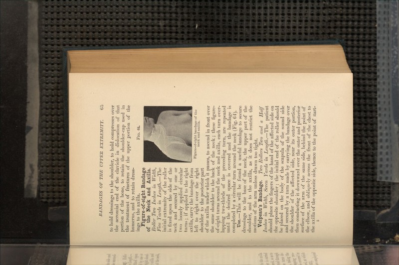 to hold dressings to the shoulder, to hold compresses over the aoromial end of the clavicle in dislocation of that portion of the bone, to retain the shoulder-cap used in the treatment of fractures of the upper portion of the humerus, and to retain dress- ings to the axilla. FIG. 64. Figure-of-eight Bandage of the Neck and Axilla. Roller Two Inches in Width, Five Yards in Length.—The initial extremity of the roller is fixed upon the side of the neck and secured by one or two loosely applied circular turns; if applied to the right axilla, carry the bandage from if. • \ , .1 • KA Figure-of-eight bandage of the left to right Over the right neck and axilla. shoulder to the posterior part of the axilla under which it passes, to ascend in front over the same shoulder to the back of the neck ; these figure- of-eight turns around the neck and axilla, each turn over- lapping two-thirds of the preceding turn, are repeated until the desired space is covered and the bandage is completed by a circular turn around the neck (Fig. 64). Use.—This will be found a useful bandage to secure dressings to the base of the neck, the upper part of the shoulder, and to the axilla, as it does not restrict the motions of the arm unless drawn too tight. Velpeau's Bandage. Two Rollers Two and a Half Inches in Width, Seven Yards in Length.—The patient should place the fingers of the hand of the affected side on the opposite shoulder; the initial end of the roller should be placed on the body of the scapula of the sound side and secured by a turn made by carrying the bandage over the shoulder of the affected side, near its outer portion, then conducting it downward over the outer and posterior surface of the arm of the same side, behind the point of the elbow, and obliquely across the front of the chest to the axilla of the opposite side, thence to the point of >tart-