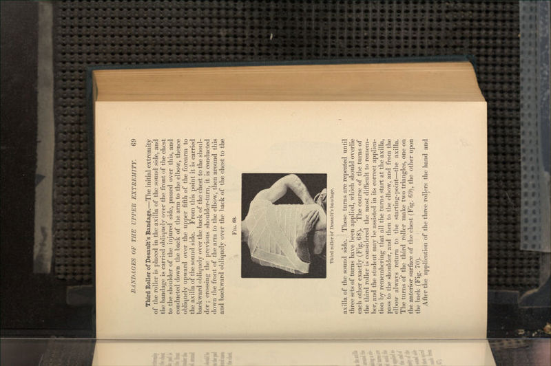 Third Roller of Desault's Bandage.—The initial extremity of the roller is placed in the axilla of the sound side, and the bandage is carried obliquely over the front of the chest to the shoulder of the injured side, passed over this, and conducted down the back of the arm to the elbow, thence obliquely upward over the upper fifth of the forearm to the axilla of the sound side. From this point it is carried backward obliquely over the back of the chest to the shoul- der ; crossing the previous shoulder-turn, it is conducted down the front of the arm to the elbow, then around this and backward obliquely over the back of the chest to the FIG. 68. Third roller bf Desault's bandage. axilla of the sound side. These turns are repeated until three sets of turns have been applied, which should overlie each other exactly (Fig. 68). The course of the turns of the third roller is considered the most difficult to remem- ber, and the student may be assisted in its correct applica- tion by remembering that all the turns start at the axilla, pass to the shoulder, and then to the elbow, and from the elbow always return to the starting-point—the axilla. The turns of the third roller make two triangles, one on the anterior surface of the chest (Fig. 69), the other upon the back (Fig. 70). After the application of the three rollers the hand and