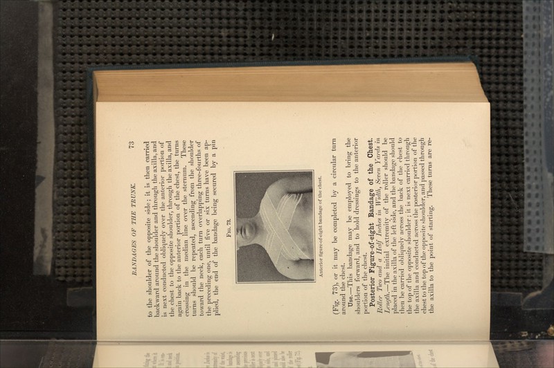 to the shoulder of the opposite side; it is then carried backward around the shoulder and through the axilla, and is next conducted obliquely over the anterior portion of the chest to the opposite shoulder, through the axilla, and again back to the anterior portion of the chest, the turns crossing in the median line over the sternum. These turns should be repeated, ascending from the shoulder toward the neck, each turn overlapping three-fourths of the preceding one, until five or six turns have been ap- plied, the end of the bandage being secured by a pin FIG. 73. Anterior figure-of-eight bandage of the chest. (Fig. 73), or it may be completed by a circular turn around the chest. Use.—This bandage may be employed to bring the shoulders forward, and to hold dressings to the anterior portion of the chest. Posterior Figure-of-eight Bandage of the Chest. Roller Two and a Half Inches in Width, Seven Yards in Length.—The initial extremity of the roller should be placed in the axilla of the left side, and the bandage should then be carried obliquely across the back of the chest to the top of the opposite shoulder; it is next carried through the axilla and conducted across the posterior portion of the chest to the top of the opposite shoulder, and passed through the axilla to the point of starting. These turns are re-