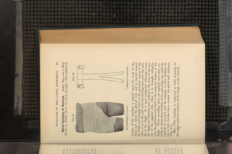 Spica-bandage of Buttock. Roller Two and a Half Inches in Width, Seven Yards in Length.—The initial ex- Fio. 81. FIG. 82. Spica-bandage of buttock. T-bandage of perineum. tremity of the bandage is placed upon the back of the thigh just below the gluteal fold, and is carried around the thigh and brought back to the posterior aspect of the limb, so as to fix and cross the starting-turn near the mid- dle of the thigh. It is next conducted obliquely across the thigh and buttocks and carried to the brim of the pel- vis of the opposite side, when it is brought obliquely over the abdomen and back to the posterior surface of the thigh. These ascending turns are applied, each turn cov- ering in about three-fourths of the preceding one, until the buttock is covered, and the bandage is then finished by one or two circular turns around the pelvis and abdomen (Fig. 81). Use.—This bandage is employed to hold dressings to the upper posterior portion of the thigh, or the buttock.