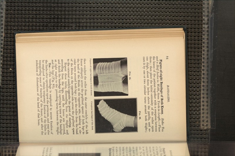 Figure-of-eight Bandage of Both Knees. RoUer Two and a Half Inches in Width, Seven Yards in Length.—Place the knees of the patient together with a compress between them; then place the initial extremity of the roller upon one thigh, about three inches above the patella, and se- cure it by one or two circular turns around both thighs; FIQ. 86. Fia. 85. Figure-of-eight bandages of both knees. Complete bandage of the foot. then conduct the roller from the outer condyle of the left femur obliquely across the popliteal spaces of both legs to the head of the fibula on the opposite side, making a cir- cular turn around both legs ; pass the roller from the head of the fibula on the opposite side across the popliteal space to the external condyle opposite the point of starting. Repeat these turns, descending from the thighs and ascending from the legs, until the knees are covered, and finish the bandage by carrying a turn of the bandage at right angles to the preceding turns between the thighs and the legs (Fig. 85). Use.—This bandage is employed to secure fixation of the limbs after operations upon the perineum, and may also be employed to obtain temporary fixation of the limbs in transporting cases of fracture of the femur, and after the reduction of dislocations of the head of that bone.