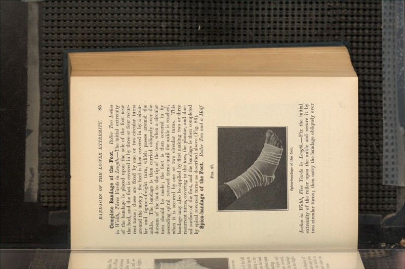 Complete Bandage of the Foot. Roller Two Inches in Width, Three Yards in Length.—The initial extremity of the bandage is placed upon the sole of the foot near the heel, and the foot is covered in by three or four recur- rent turns; these are fixed by one or two circular turns around the instep; the heel is then covered in by a circu- lar and figure-of-eight turn, which passes around the ankle. The bandage is then carried obliquely over the dorsum of the foot to the tip of the toes, when a circular turn should be made; the foot is then covered in by ascending spiral reversed turns until the ankle is reached, when it is secured by one or two circular turns. This bandage may also be applied by first making two or three recurrent turns, covering in the toes, the plantar, and dor- sal surface of the foot, and the bandage is then completed by spiral reversed turns as described above (Fig. 86). Spica-bandage of the Foot. Roller Two and a Hal/ FIG. 87. Spica-baudage of the foot. Inches in Width, Five Yards in Length.—Fix the initial extremity of the roller upon the ankle and secure it by two circular turns; then carry the bandage obliquely over