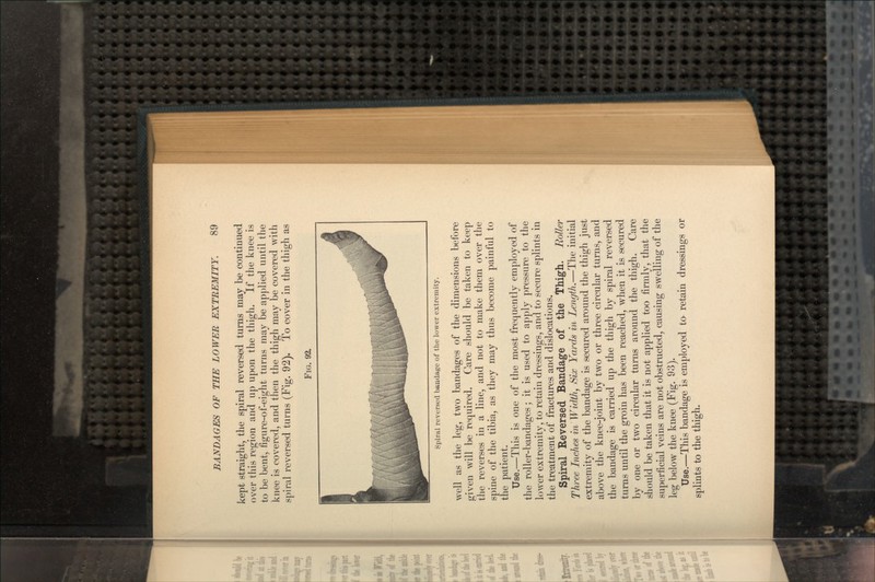 kept straight, the spiral reversed turns may be continued over this region and up upon the thigh. If the knee is to be bent, figure-of-eight turns may be applied until the knee is covered, and then the thigh may be covered with spiral reversed turns (Fig. 92). To cover in the thigh as FIG. 92. Spiral reversed bandage of the lower extremity. well as the leg, two bandages of the dimensions before given will be required. Care should be taken to keep the reverses in a line, and not to make them over the spine of the tibia, as they may thus become painful to the patient. Use.—This is one of the most frequently employed of the roller-bandages; it is used to apply pressure to the lower extremity, to retain dressings, and to secure splints in the treatment of fractures and dislocations. Spiral Reversed Bandage of the Thigh. Roller Three Inches in Width, Six Yards in Length.—The initial extremity of the bandage is secured around the thigh just above the knee-joint by two or three circular turns, and the bandage is carried up the thigh by spiral reversed turns until the groin has been reached, when it is secured by one or two circular turns around the thigh. Care should be taken that it is not applied too firmly, that the superficial veins are not obstructed, causing swelling of the leg below the knee (Fig. 93). Use.—This bandage is employed to- retain dressings or splints to the thigh.