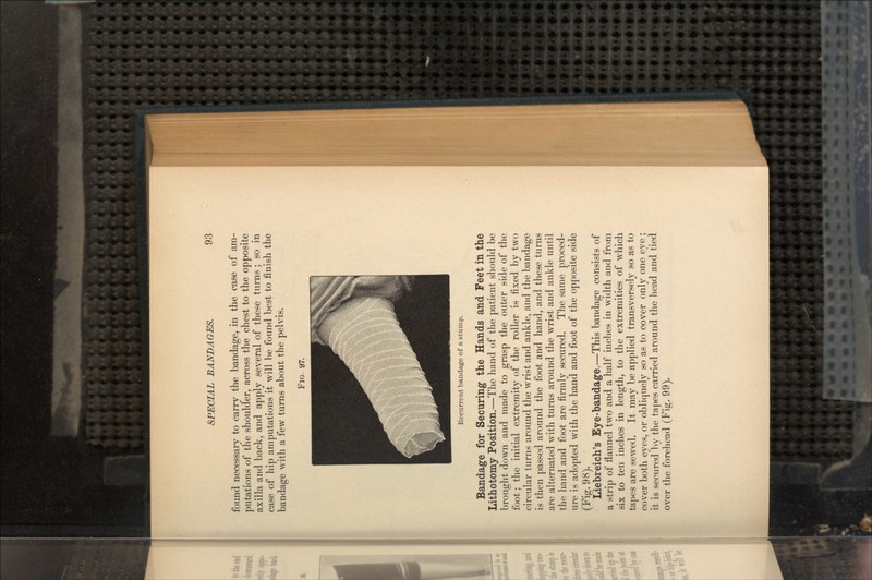 found necessary to carry the bandage, in the case of am- putations of the shoulder, across the chest to the opposite axilla and back, and apply several of these turns; so in case of hip amputations it will be found best to finish the bandage with a few turns about the pelvis. FIG Recurrent bandage of a stump. Bandage for Securing the Hands and Feet in the Lithotomy Position.—The hand of the patient should be brought down and made to grasp the outer side of the foot; the initial extremity of the roller is fixed by two circular turns around the wrist and ankle, and the bandage is then passed around the foot and hand, and these turns are alternated with turns around the wrist and ankle until the hand and foot are firmly secured. The same proced- ure is adopted with the hand and foot of the opposite side (Fig. 98). Liebreich's Eye-bandage.—This bandage consists of a strip of flannel two and a half inches in width and from six to ten inches in length, to the extremities of which tapes are sewed. It may be applied transversely so as to cover both eyes, or obliquely so as to cover only one eye ; it is secured by the tapes carried around the head and tied over the forehead (Fig. 99).