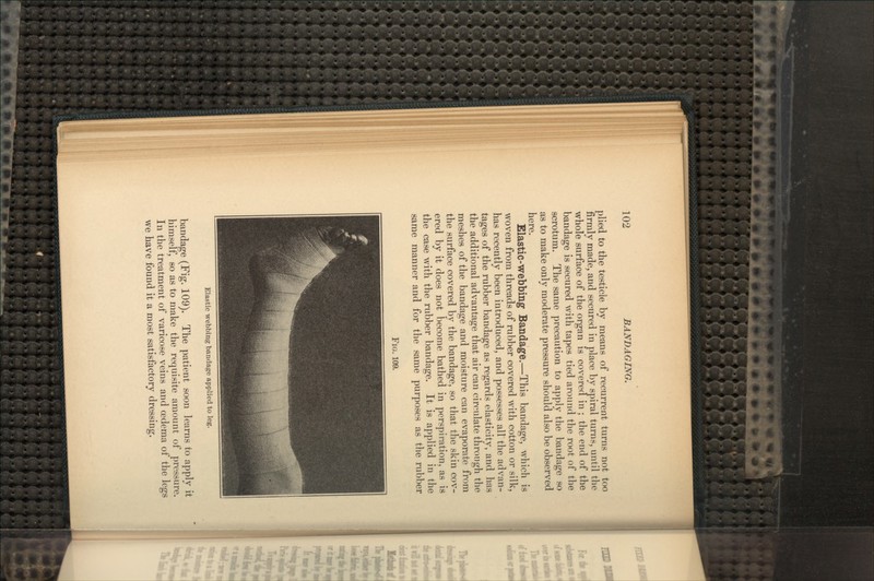 plied to the testicle by means of recurrent turns not too firmly made, and secured in place by spiral turns, until the whole surface of the organ is covered in ; the end of the bandage is secured with tapes tied around the root of the scrotum. The same precaution to apply the bandage so as to make only moderate pressure should also be observed here. Elastic-webbing Bandage.—This bandage, which is woven from threads of rubber covered with cotton or silk, has recently been introduced, and possesses all the advan- tages of the rubber bandage as regards elasticity, and has the additional advantage that air can circulate through the meshes of the bandage and moisture can evaporate from the surface covered by the bandage, so that the skin cov- ered by it does not become bathed in perspiration, as is the case with the rubber bandage. It is applied in the same manner and for the same purposes as the rubber FIG. 109. Elastic webbing bandage applied to leg. bandage (Fig. 109). The patient soon learns to apply it himself, so as to make the requisite amount of pressure. In the treatment of varicose veins and oedema of the legs we have found it a most satisfactory dressing.