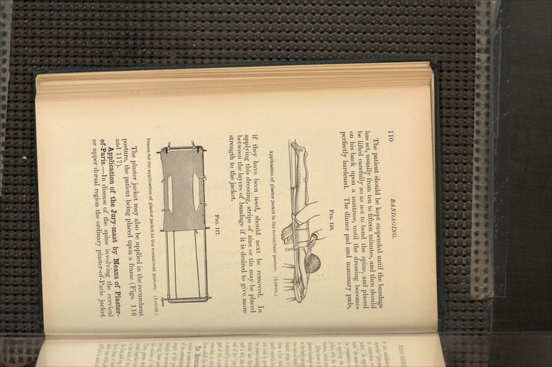 The patient should be kept suspended until the bandage has set, usually from ten to fifteen minutes, and then should be lifted carefully so as not to bend the spine, and placed on his back upon a mattress, until the dressing becomes perfectly hardened. The dinner pad and mammary pads, FIG. 116. Application of plaster jacket in the recumbent posture. (Lovett.) if they have been used, should next be removed. In applying this dressing, strips of zinc or tin may be placed between the layers of bandage if it is desired to give more strength to the jacket. FIG. 117. Frame for the application of plaster jacket in the recumbent posture. (Lovett.) The plaster jacket may also be applied in the recumbent posture, the patient being placed upon a frame (Figs. 116 and 117). Application of the Jury-mast by Means of Plaster- of-Paris.—In disease of the spine involving the cervical or upper dorsal region the ordinary plaster-of-Paris jacket