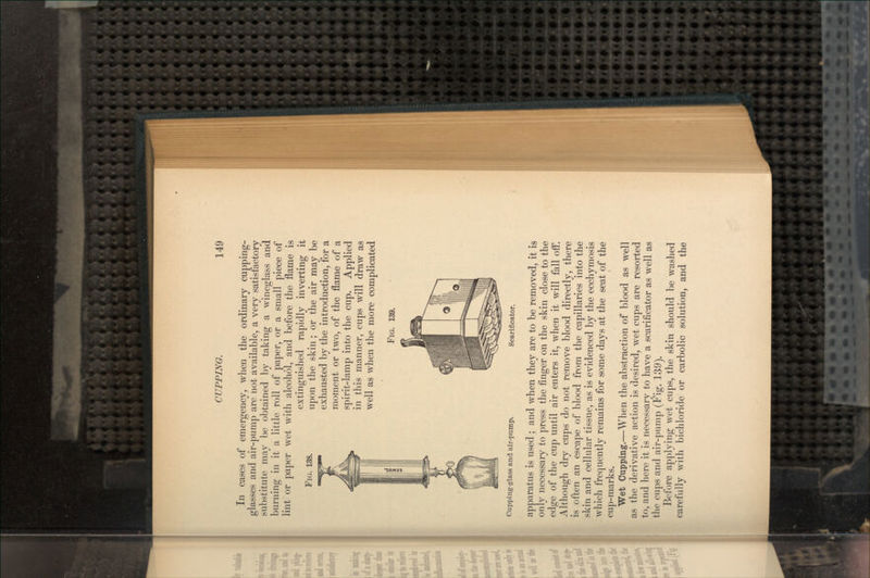 In cases of emergency, when the ordinary cupping- glasses and air-pump are not available, a very satisfactory substitute may be obtained by taking a wineglass and burning in it a little roll of paper, or a small piece of lint or paper wet with alcohol, and before the flame is extinguished rapidly inverting it FIG. 138. upon the skin; or the air may be exhausted by the introduction, for a moment or two, of the flame of a spirit-lamp into the cup. Applied in this manner, cups will draw as well as when the more complicated FIG. 139. Cupping-glass and air-pump. Scarificator. apparatus is used ; and when they are to be removed, it is only necessary to press the finger on the skin close to the edge of the cup until air enters it, when it will fall off. Although dry cups do not remove blood directly, there is often an escape of blood from the capillaries into the skin and cellular tissue, as is evidenced by the ecchymosis which frequently remains for some days at the seat of the cup-marks. Wet Cupping.—When the abstraction of blood as well as the derivative action is desired, wet cups are resorted to, and here it is necessary to have a scarificator as well as the cups and air-pump (Fig. 139). Before applying wet cups, the skin should be washed carefully with bichloride or carbolic solution, and the