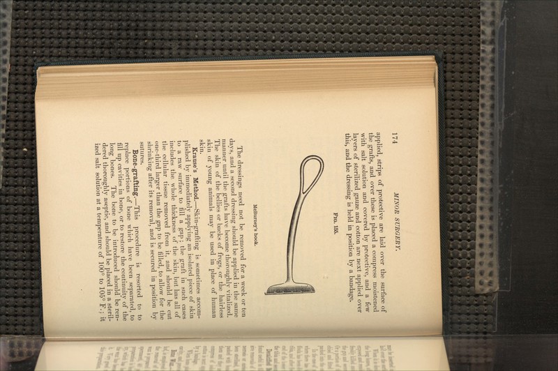 applied, strips of protective are laid over the surface of the grafts, and over these is placed a compress moistened with salt solution and covered by protective, and a few layers of sterilized gauze and cotton are next applied over this, and the dressing is held in position by a bandage. FIG. 155. McBurney's hook. The dressings need not be removed for a week or ten days, and a second dressing should be applied in the same manner until the grafts have become thoroughly vitalized. The skin of the bellies or backs of frogs, or the hairless skin of young animals may be used in place of human skin. Krause's Method.—Skin-grafting is sometimes accom- plished by immediately applying an isolated piece of skin to a raw surface to till a gap; the graft in such cases includes the whole thickness of the skin, but has all of the cellular tissue removed from it, and should be cut one-third larger than the gap to be filled, to allow for the shrinking after its removal, and is secured in position by sutures. Bone-grafting.—This procedure is resorted to to replace portions of bone which have been separated, to fill up cavities in bone, or to restore the continuity of the long bones. The bone to be introduced should be ren- dered thoroughly aseptic, and should be placed in a steril- ized salt solution at a temperature of 100° to 105° F.J it