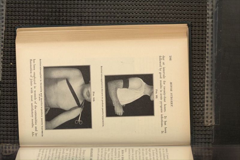 day at intervals for twenty-four hours. It has been followed by good results in acute pyogenic infections. It FIG. 162. Rubber tube applied to the arm to produce passive hyperaemia. FIG. 163. Rubber tube applied to the axilla and shoulder to produce passive hyperamia of arm. has been employed in wounds of the extremities and in- flammation of joints with most satisfactory results. Ab-