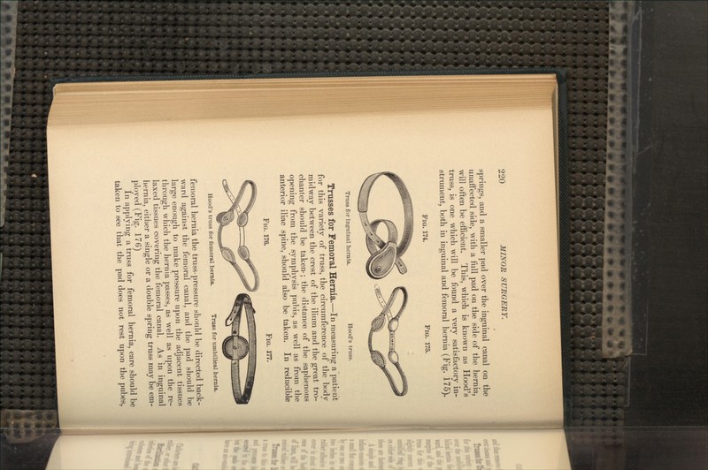 springs, and a smaller pad over the inguinal canal on the unaffected side, with a full pad on the side of the hernia, will often be efficient. This, which is known as Hood's truss, is one which will be found a very satisfactory in- strument, both in inguinal and femoral hernia (Fig. 175). PIG. 174. FIG. 175. Truss for inguinal hernia. Hood's truss. Trusses for Femoral Hernia.—In measuring a patient for this variety of truss, the circumference of the body midway between the crest of the ilium and the great tro- chanter should be taken-; the distance of the saphenous opening from the symphysis pubis, as well as from the anterior iliac spine, should also be taken. In reducible FIG. 176. FIG. 177. Hood's truss for femoral hernia. Truss for umbilical hernia. femoral hernia the truss-pressure should be directed back- ward against the femoral canal, and the pad should be large enough to make pressure upon the adjacent tissues through which the hernia passes, as well as upon the re- laxed tissues covering the femoral canal. As in inguinal hernia, either a single or a double spring truss may be em- ployed (Fig. 176) In applying a truss for femoral hernia, care should be taken to see that the pad does not rest upon the pubes,