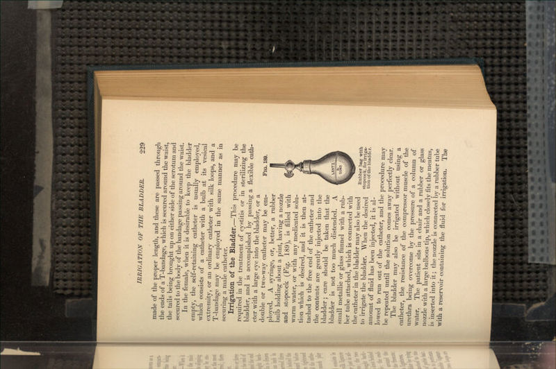 FIQ. 189. made of the proper length, and these are passed through the ends of a T-bandage, which is secured around the waist, the tails being brought up on either side of the scrotum and secured to the body of the bandage passing around the waist. In the female, when it is desirable to keep the bladder empty, the self-retaining catheter is usually employed, which consists of a catheter with a bulb at its vesical extremity, or an ordinary catheter with silk loops, and a T-bandage may be employed in the same manner as in securing a male catheter. Irrigation of the Bladder.—This procedure may be required in the treatment of cystitis or in sterilizing the bladder, and is accomplished by passing a flexible cath- eter with a large eye into the bladder, or a double or two-way catheter may be em- ployed. A syringe, or, better, a rubber bulb holding about a pint, having a nozzle and stopcock (Fig. 189), is filled with warm water, or with any medicated solu- tion which is desired, and it is then at- tached to the free end of the catheter and the contents are gently injected into the bladder; care should be taken that the bladder is not too much distended. A small metallic or glass funnel with a rub- ber tube attached, which is connected with the catheter in the bladder may also be used to irrigate the bladder. When the desired amount of fluid has been injected, it is al- lowed to run out of the catheter, and the procedure may be repeated until the solution comes away perfectly clear. The bladder may also be irrigated without using a catheter, the resistance of the compressor muscle of the urethra being overcome by the pressure of a column of water. The patient sits in a chair and a rubber or glass nozzle with a large bulbous tip, which closely fits the meatus, is inserted into it; the nozzle is connected by a rubber tube with a reservoir containing the fluid for irrigation. The Rubber bag with stopcock, for irriga- tion of the bladder.